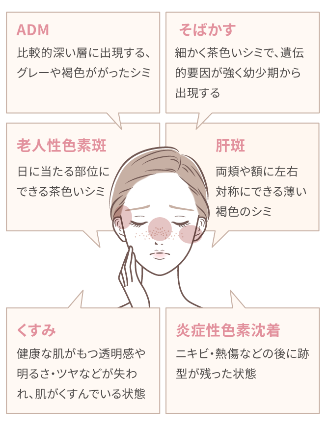 ADM:比較的深い層に出現する、グレーや褐色がかかったシミ、そばかす：細かく茶色いシミで、遺伝的要因が強く幼少期から出現する、老人性色素斑：日に当たる部位にできる茶色いシミ、肝斑：両頬や額に左右対称にできる薄い褐色のシミ、くすみ：健康な肌がもつ透明感や明るさ・ツヤなどが失われ、肌がくすんでいる状態、炎症性色素沈着：ニキビ・熱唱などの後に跡型が残った状態