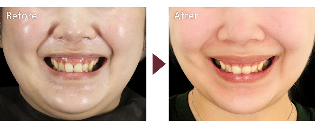 ガミースマイル